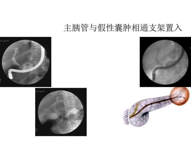 ercp下胆道胰管支架置入ppt