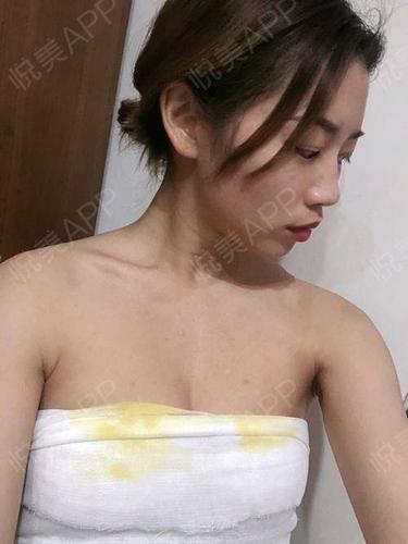 术后1天_自体脂肪术后1天_胸部整形术后1天_唐伯虎点蚊香分享图片7