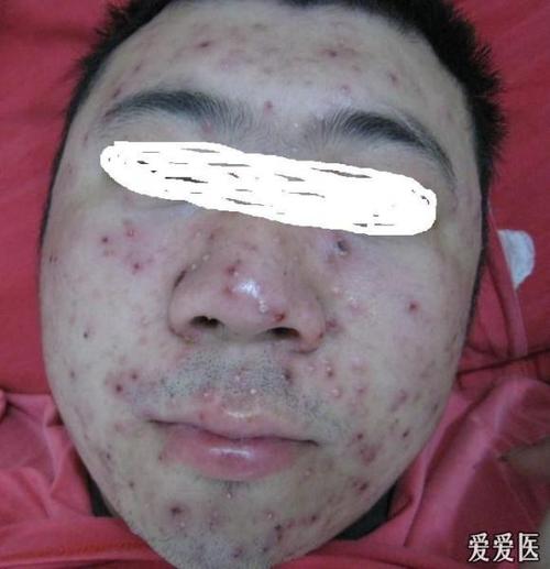 成人水痘伴感染