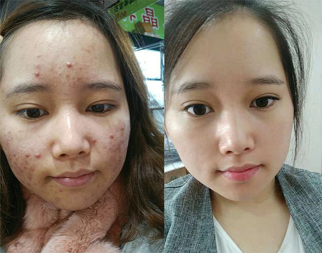 神奇原液祛痘有效果吗,对祛痘印有用吗,用过的告诉真相!