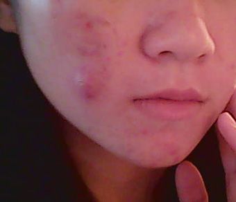 脸上隆起感染性痤疮图片