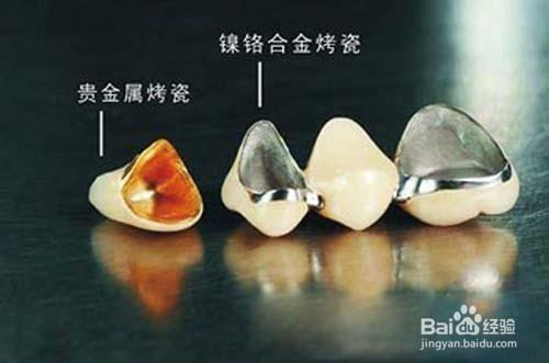 补牙牙套的相关问题