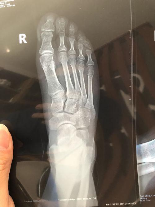 右脚第五跖骨骨折