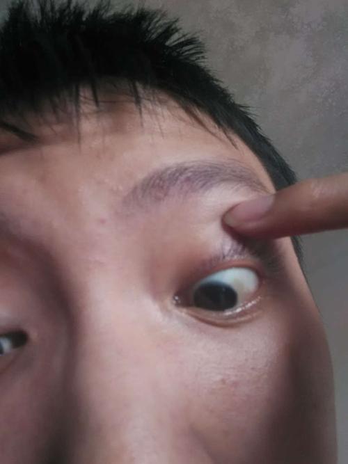 结膜色素沉着斑可以手术治疗