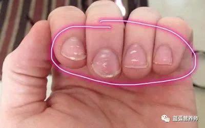 可能是有蛔虫,嘉兴市第一医院,宝宝指甲上有白点是怎么回事简介健康