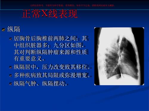 胸部肺和纵隔课件.ppt 32页