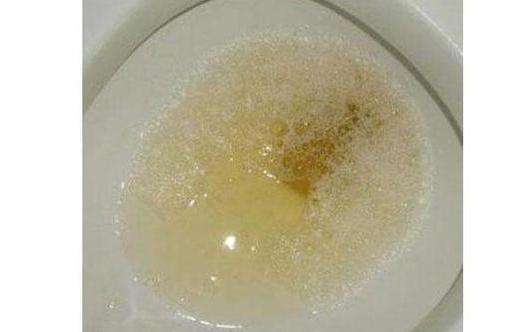 做好4点或能改善尿蛋白!