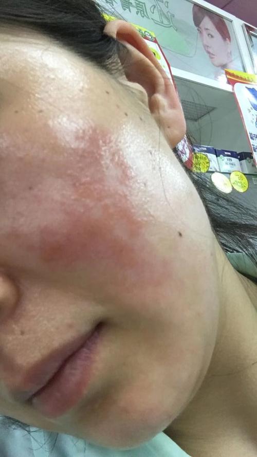 过敏性皮炎修复