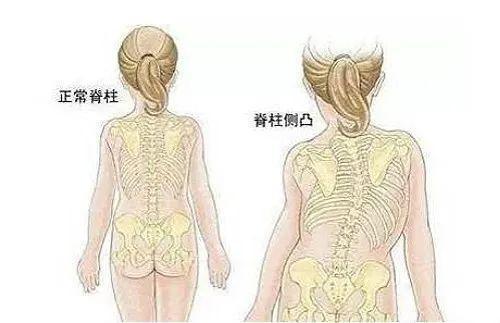 4个月宝宝被查出"脊柱变形",只因妈妈带他出门时,总是