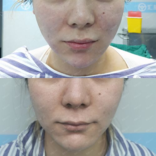 面吸术后即刻效果对比面吸口角囊袋/下颌缘,即刻见效