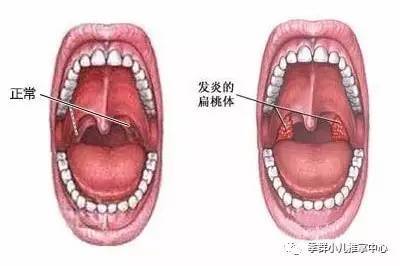预防急性扁桃体炎手抄报 预防近视手抄报