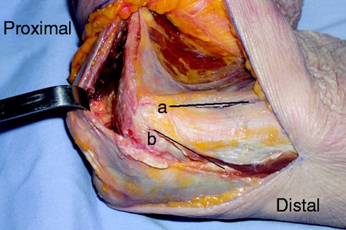 2015aaos:桡骨近端显露首选 kaplan 入路