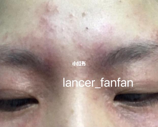 脂溢性皮炎,因为是全脸一起卸妆的,所以连眼皮根部全部发了皮炎…真的