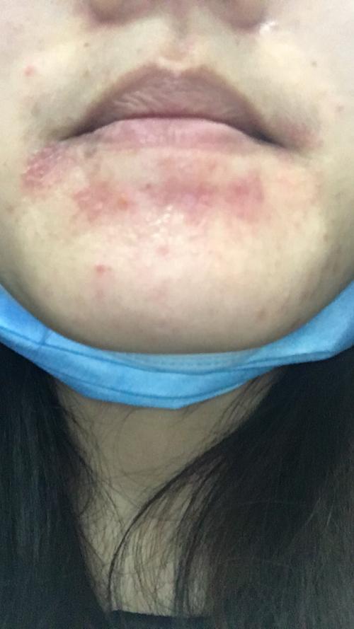 脸部红疹 是湿疹还是疱疹还是皮炎?