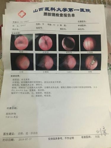 2018——7——17膀胱镜