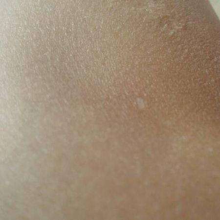 我手臂上有白癜风,哪里治疗最好啊 2011-04-14 重庆手臂上有块白斑,不