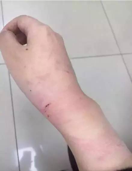当时女子手腕受伤