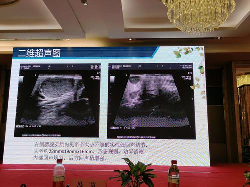 腮腺混合瘤和warthin瘤