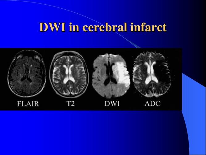 dwi in cerebral infarct