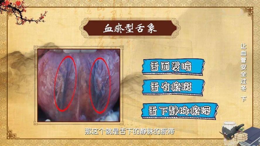 血瘀证舌象有三个特点,第一  舌象色泽较暗 淡,第二  舌上可能有瘀斑.