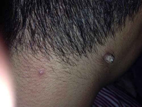 皮肤性病科 皮肤科 → 脖子后面长了一个猴子,黄豆大小头上面还一