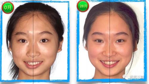 缺一颗侧切牙,中线不齐,前突,拔牙矫正