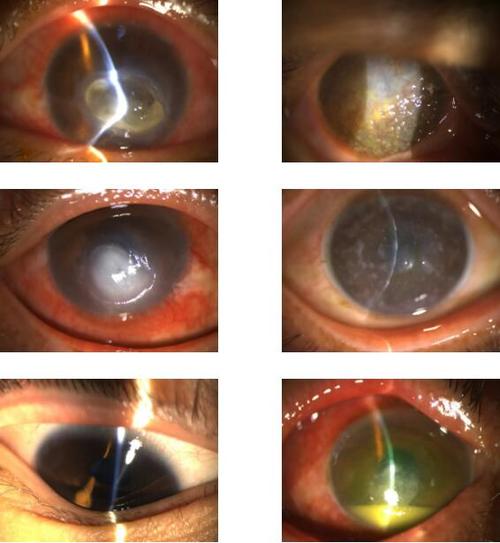 角膜炎症状图片