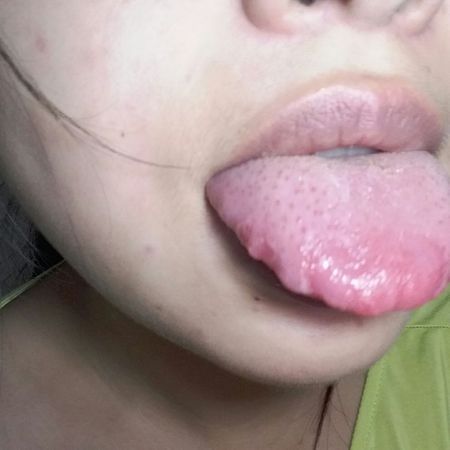 痛,破皮有白圈,舌尖和侧部颗粒变大,侧里还有裂纹,请问我怎么了,是