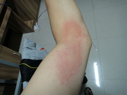 预防宝宝被虫咬皮炎图片