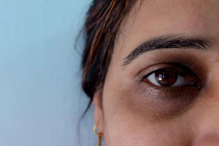 图片来源:图虫创意 眼睛周围大家都知道,是我们人体皮肤最薄的地方