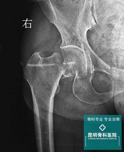 x光示右股骨颈骨折