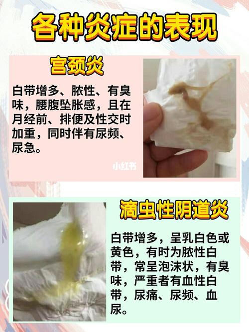 你的白带是什么样子呢?对比一下是否正常吧_妇科炎症