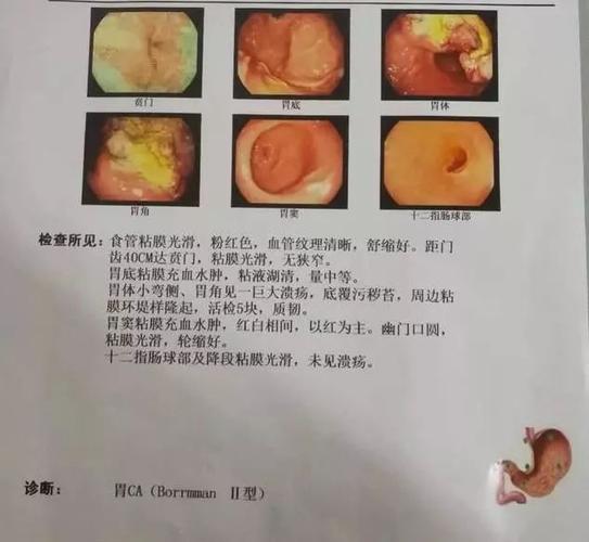 43岁老师,因拒绝胃镜,拖成晚期胃癌.