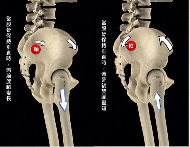 骨盆前旋的机理与纠正手法操作
