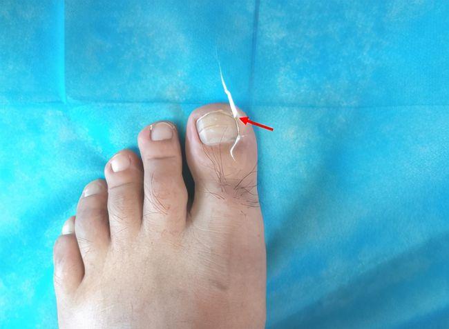 得了甲沟炎怎么办别慌医生教你居家治疗赶紧学起来