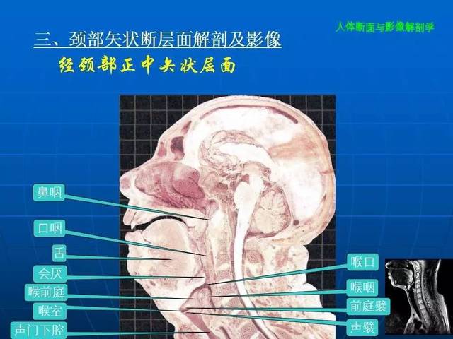 颈部断面与影像解剖