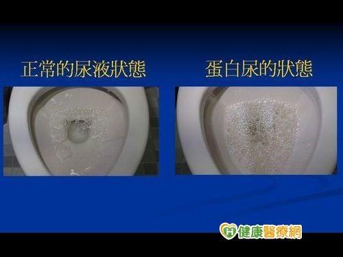 张同学尿液中有严重蛋白尿,此外还合并有血脂异常,血中白蛋白正常值为