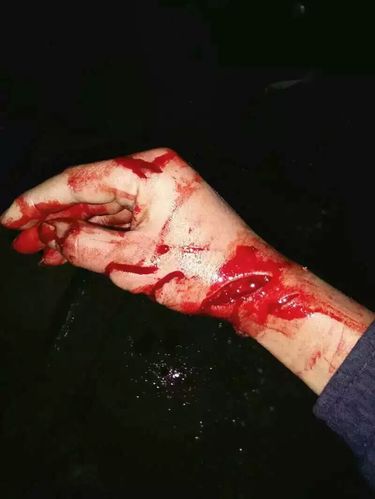 昨晚打架出来的伤口 我感到自卑