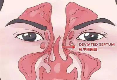 鼻中隔偏曲在什么情况下才需要做手术快来听专家怎么说
