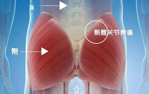 骶髂关节痛,不明的"腰痛,屁股痛"到底是啥?