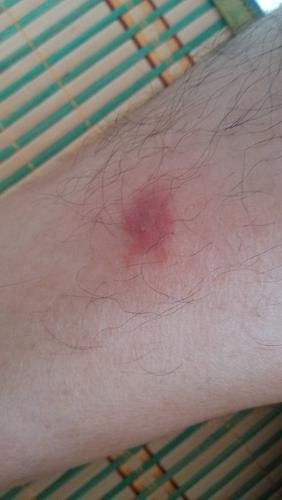 请教一下腿上长的这些红疹到底是啥,去医院看,各种说法,过敏,湿气