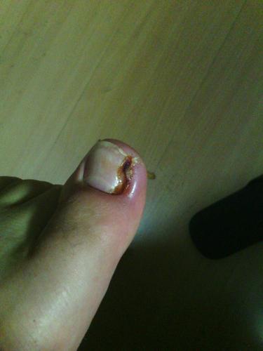 甲沟炎化脓了,前几天磕破流出来好多脓,我该怎么办,可以不去医院吗