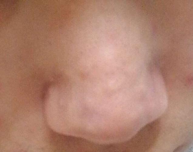 鼻子增生痘疤该怎么治疗?