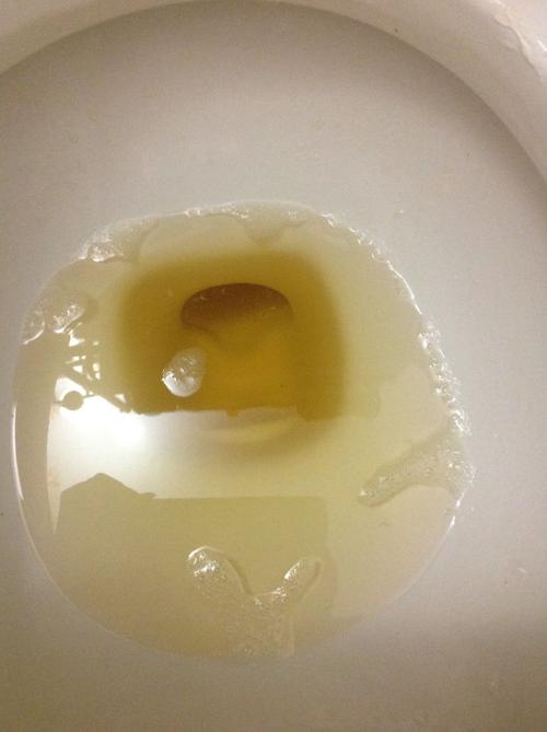 这是蛋白尿吗?刚开始很多泡沫,10分钟后才慢慢减少的照片里的数量.