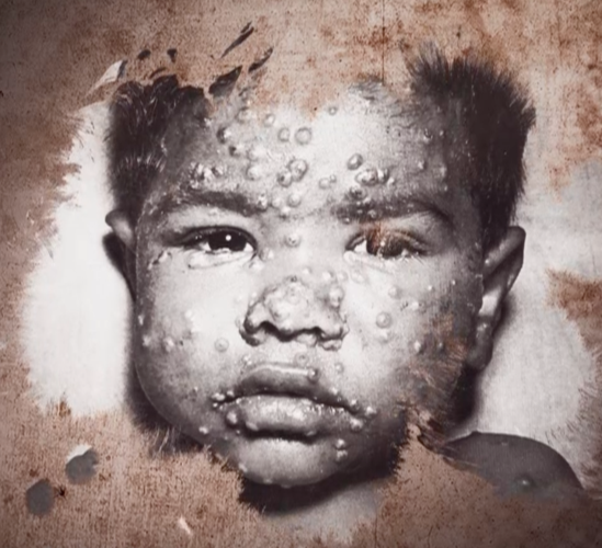 曾造成数亿人死亡的"天花",在中国是怎样被彻底消灭掉的?