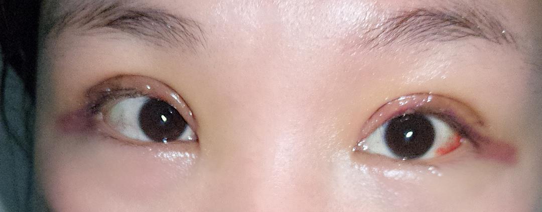 9.27晚上,涂了红霉素眼膏