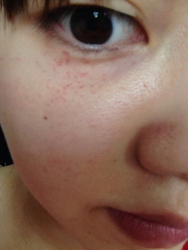 昨天呕吐后,吐了挺长时间,抬头一看眼睛下面布满了红色斑点和血丝