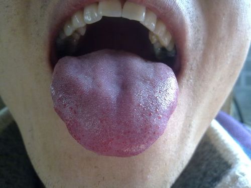 大夫帮看看我的舌头是艾滋病的毛状白斑吗