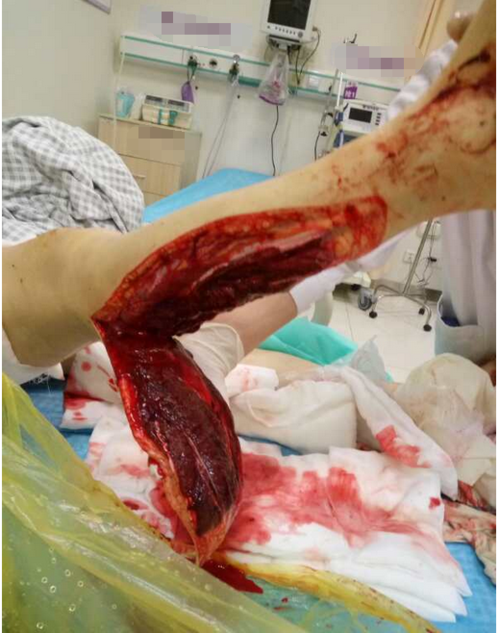 小腿逆行肌肉撕皮肤软组织脱伤一例