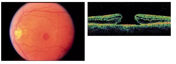 全层黄斑裂孔眼底彩照与oct图像
